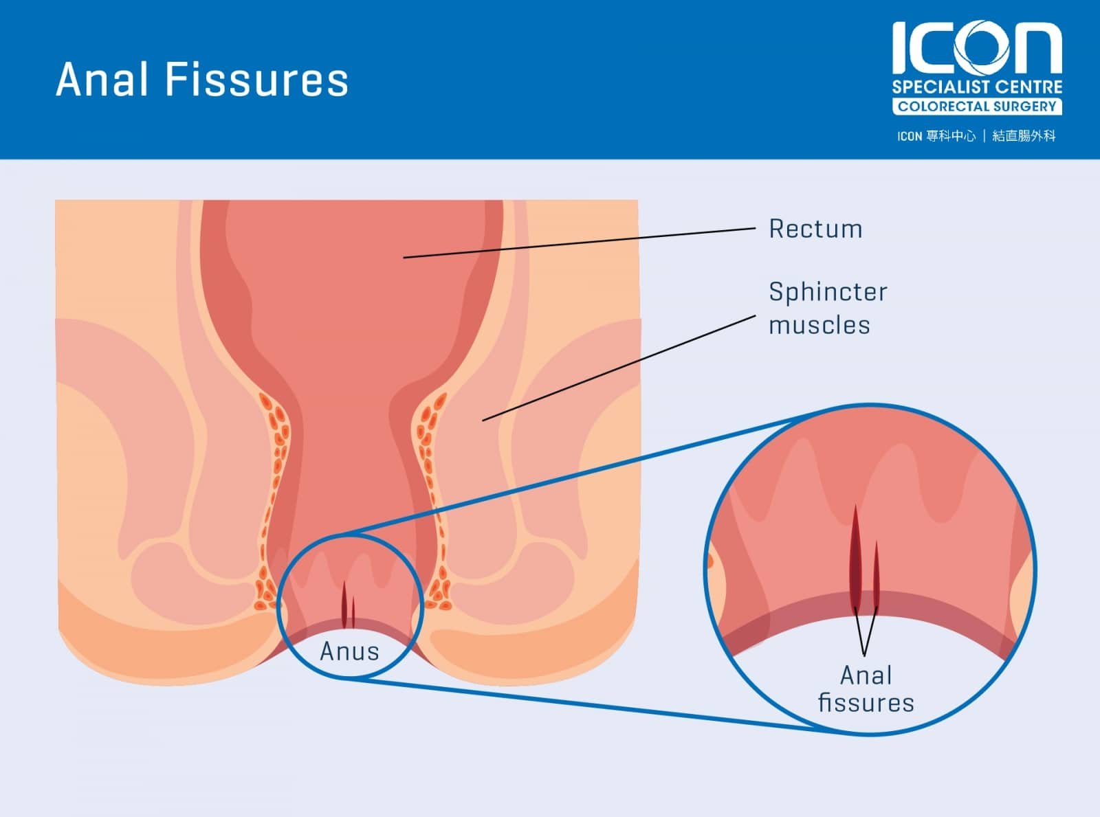 Anal Fissure; Cause, Treatment, Prevention | wasiclinic